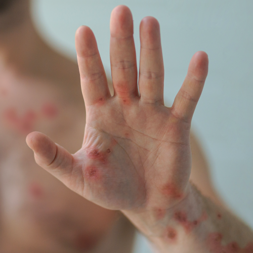 How Mpox (Monkeypox) Is Treated
