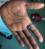 Example of a Monkeypox Rash