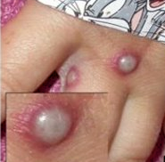 Monkeypox lesions on hand