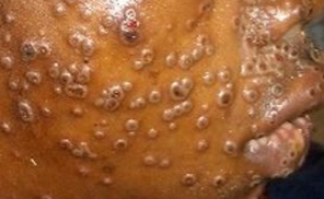 Monkeypox lesions on face