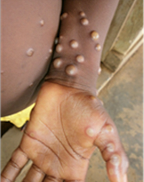Monkeypox lesions on arm