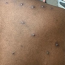 mpox lesions