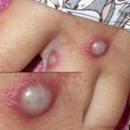 mpox lesions