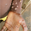 mpox lesions