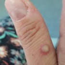 monkeypox lesion - thumb