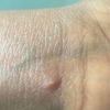 monkeypox lesion - wrist