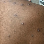 monkeypox lesions - back