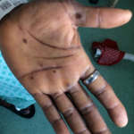monkeypox lesions - hand