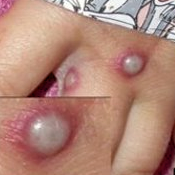 monkeypox lesions - fingers