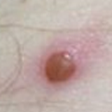 monkeypox lesion - close-up