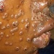 How Mpox (Monkeypox) Is Treated