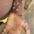 monkeypox lesions - hand and wrist